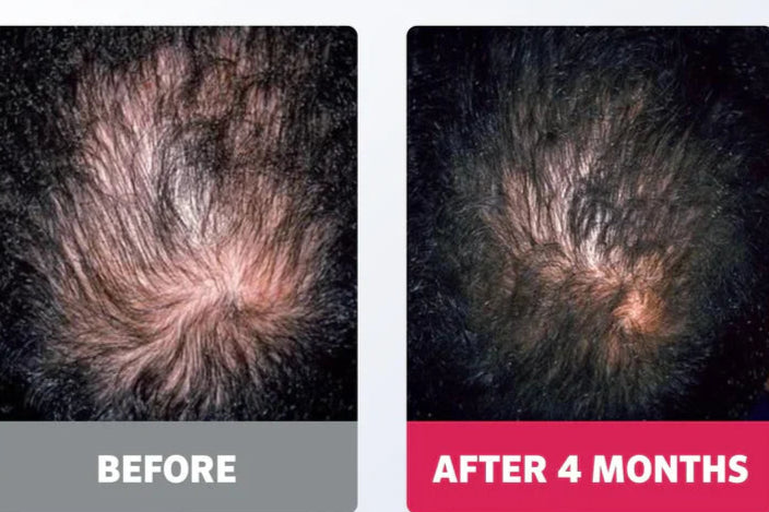 Minoxidil Solution High Strength